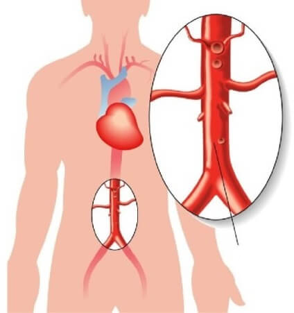 Abdominal aorta