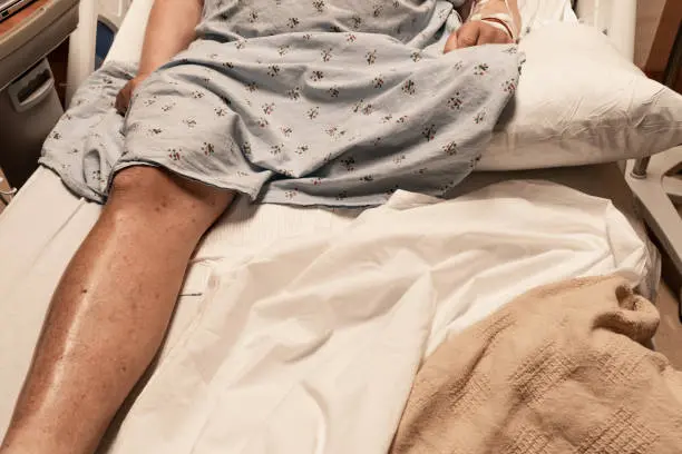 Imagen de amputación de pierna