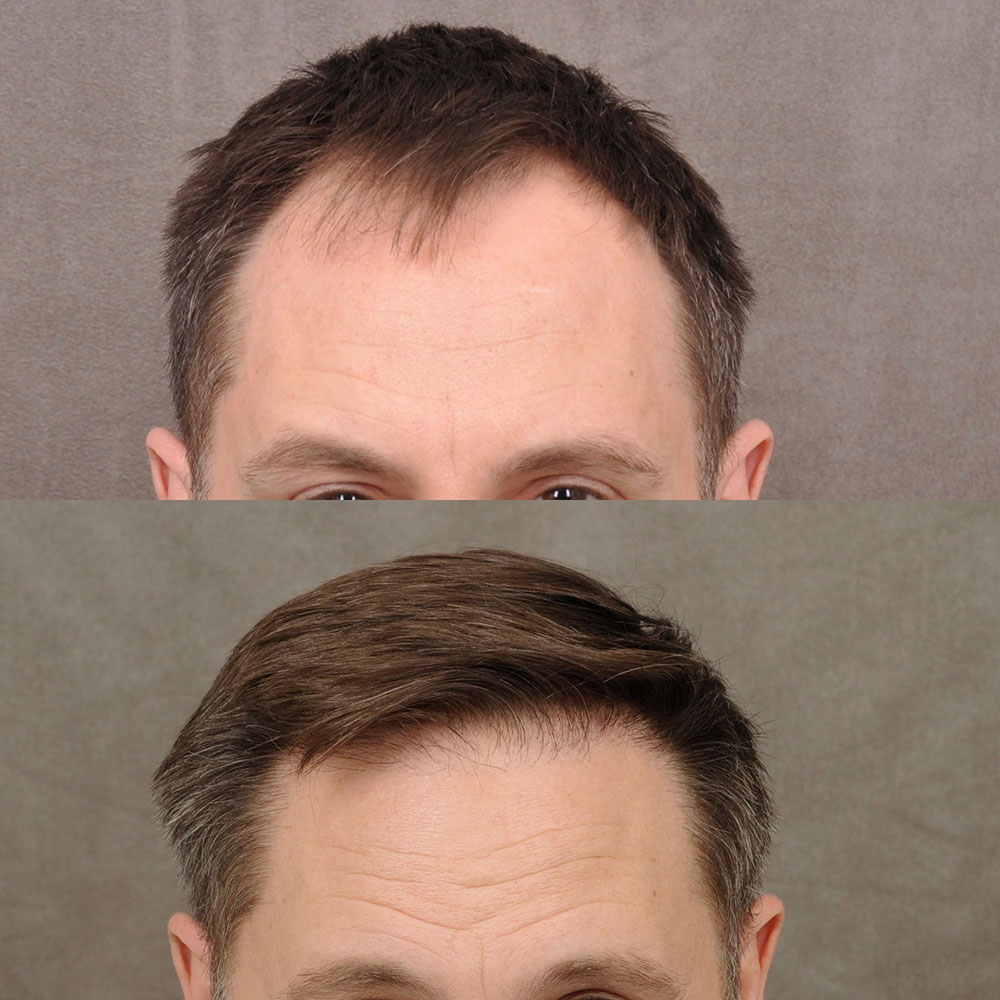 FUE-hair-transplant-3.jpg