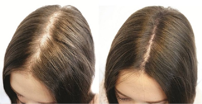 FUE-hair-transplant-3.jpg