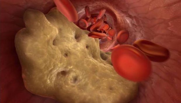 Cholesterol plaques