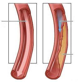 Artery