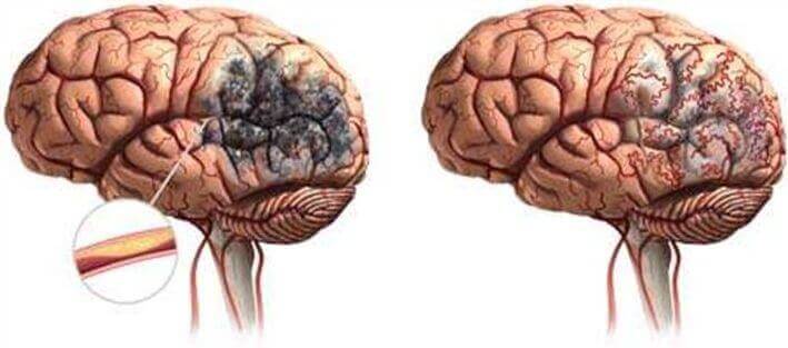 Brain stroke