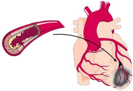 Сardiac ischemia