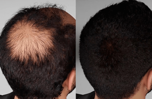 photo before and after treatment