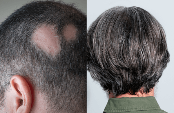 photo before and after treatment