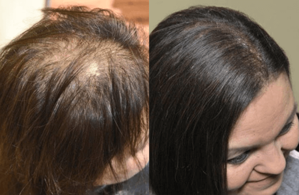 photo before and after treatment