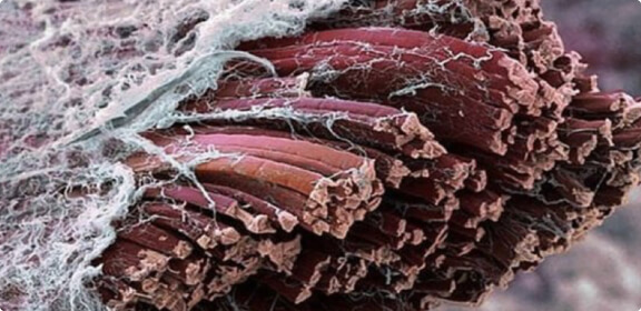 The fungal infection caused tissue necrosis 